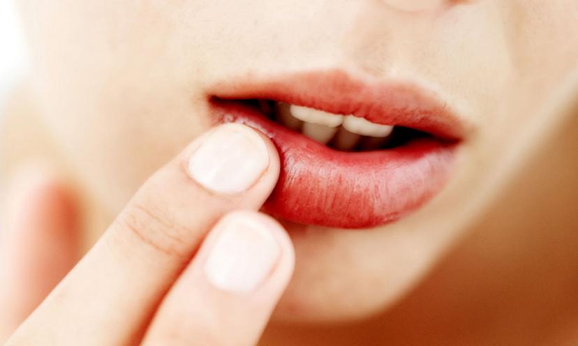How To Remedy Chapped Lips