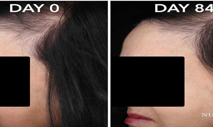 Regain Confidence and Healthy Hair with FDA Approved NUTRASTIM!